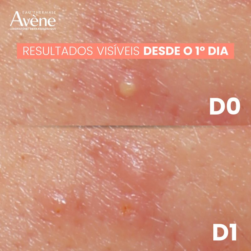 Creme-Intensivo-Avene-Cleanance-Comedomed-Peeling-40ml---4